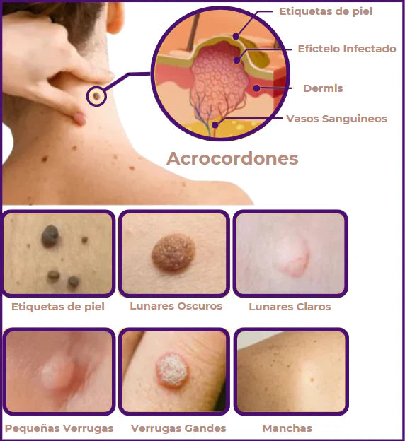 Eliminador de Verrugas® 2x1 SOLO HOY + ENVIO GRATIS